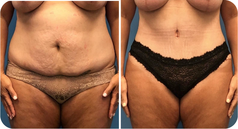 Before and after mommy makeover comparison