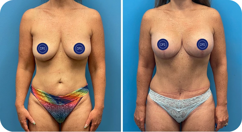 Before and after mommy makeover comparison