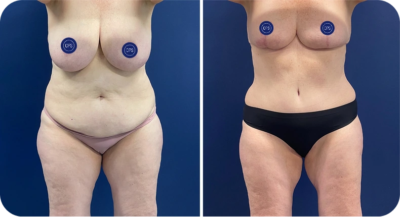 Before and after mommy makeover comparison