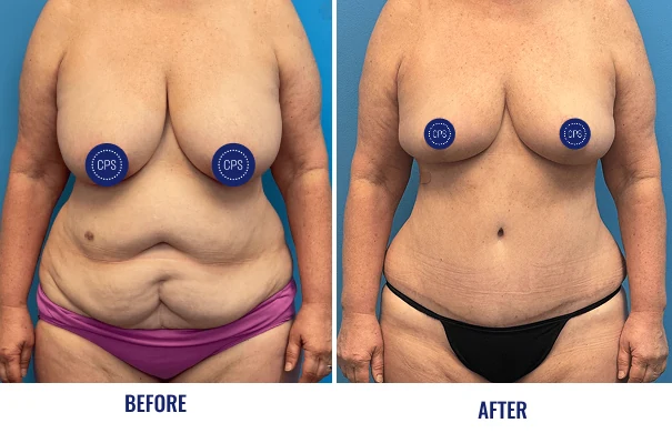 Before and after mommy makeover results