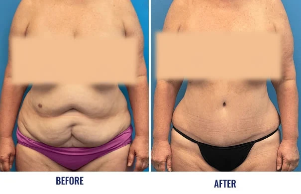 Before and after mommy makeover results