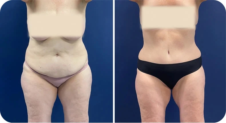 Before and after mommy makeover comparison