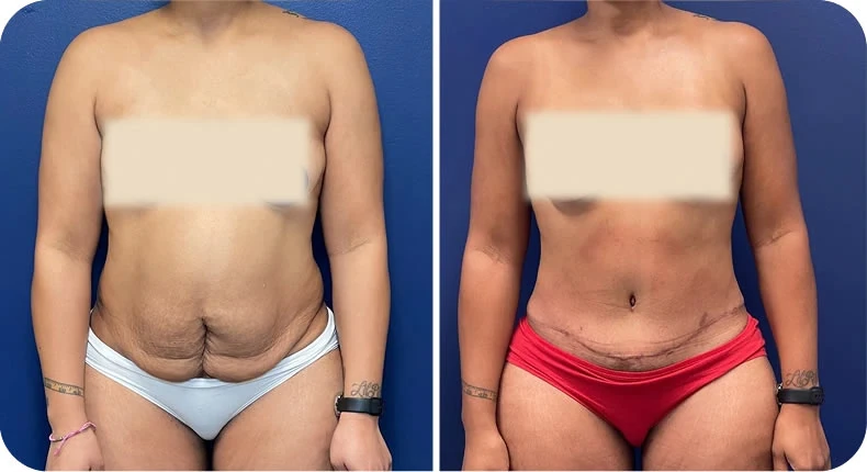 Before and after mommy makeover comparison