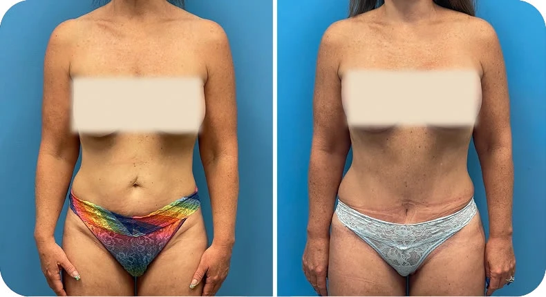 Before and after mommy makeover comparison