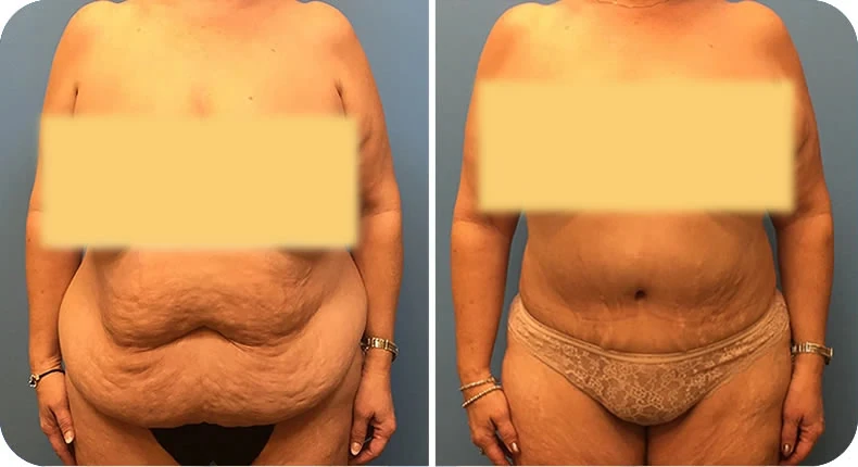 Before and after mommy makeover comparison