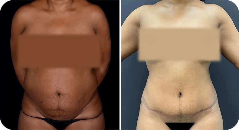 Before and after mommy makeover comparison