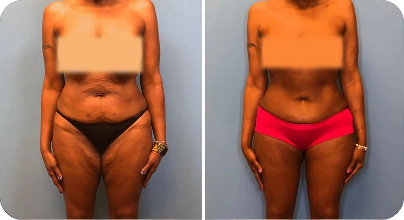 Before and after mommy makeover comparison