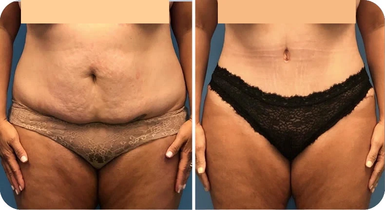 Before and after mommy makeover comparison