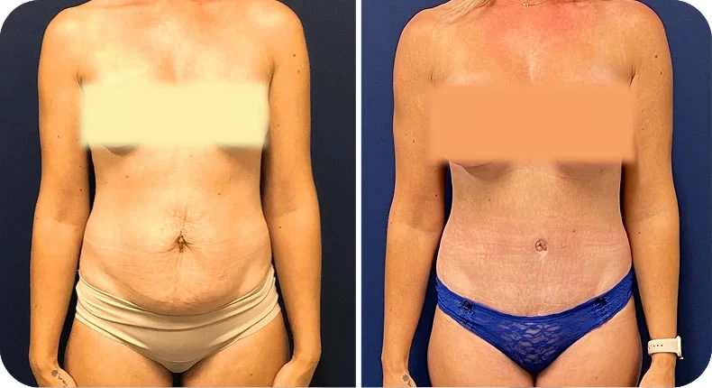 Before and after mommy makeover comparison